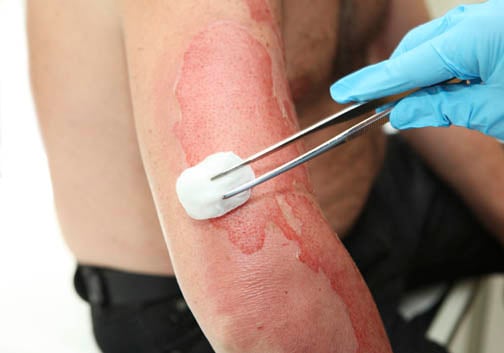 How to Treat a Burn - If you suffer a burn, there are some immediate steps you can take to ensure proper care is received, including first aid and home remedies. Burn treatment, treating burns.